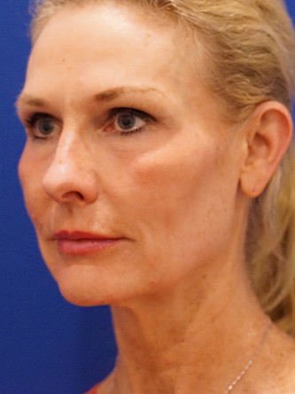 Mini Facelift* — Before