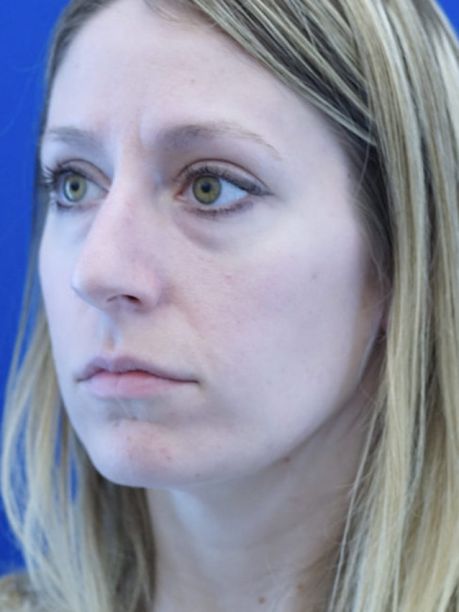 Nasal Profile Finesse — Before
