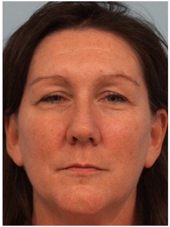 Botox Browlift2* — Before