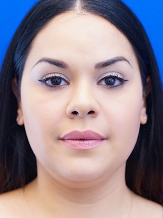 Twin Tear Trough Fillers* — After