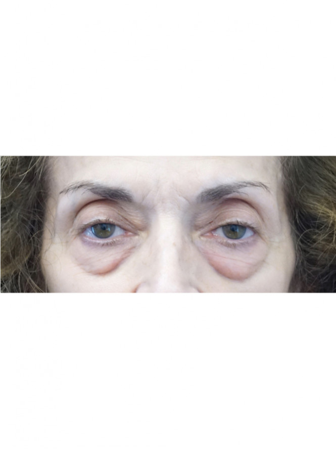 Quad Eyelid Rejuvenation — Before