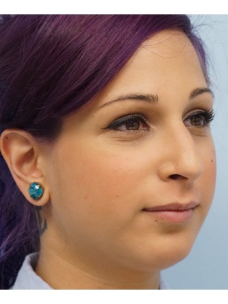Juvederm Upper and Lower Lip Fillers* — Before