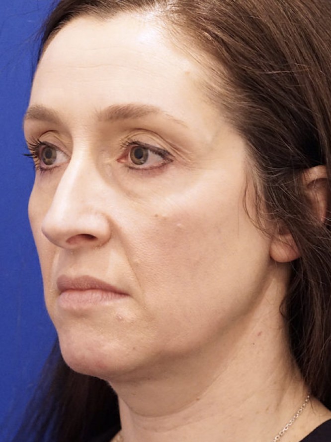 Nasal Aesthetic Nuances — Before