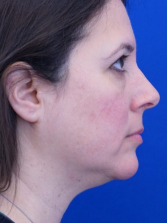 Facelift, Eyelid Lift, and Chin Liposuction* — Before