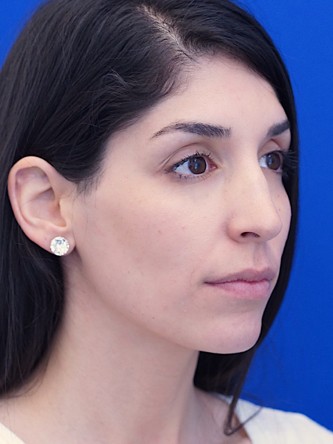 Nasal Bridge Bump* — Before