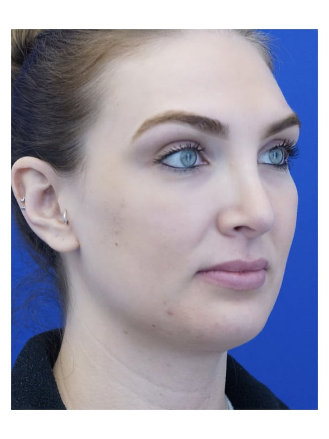 Tension Nose — After