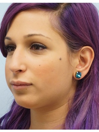 Juvederm Upper and Lower Lip Fillers* — After