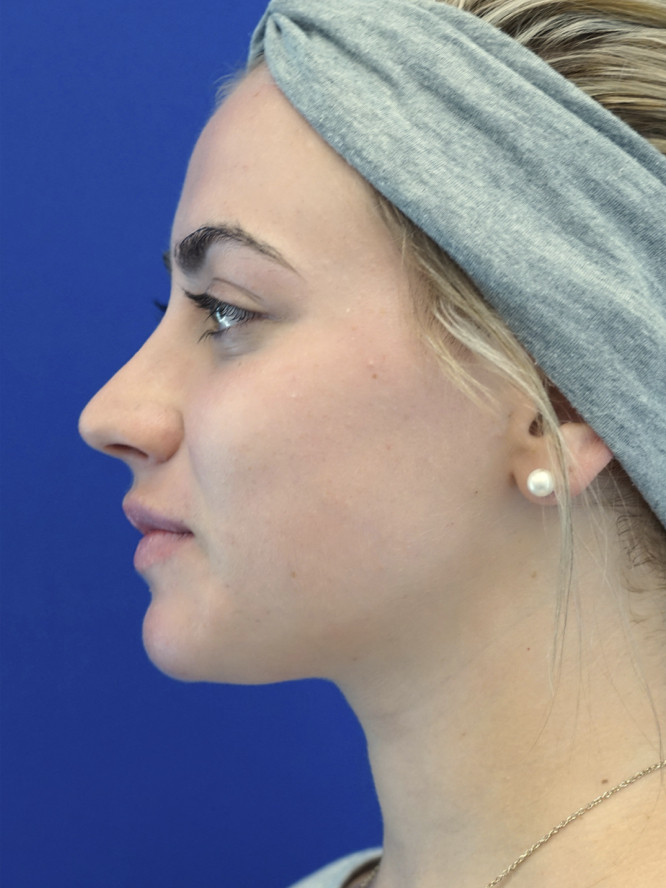 Smooth Dorsal Contour — After