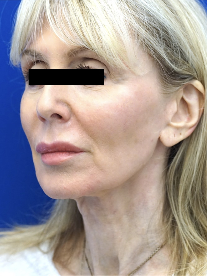Necklift Lateral Platysma Suspension — Before