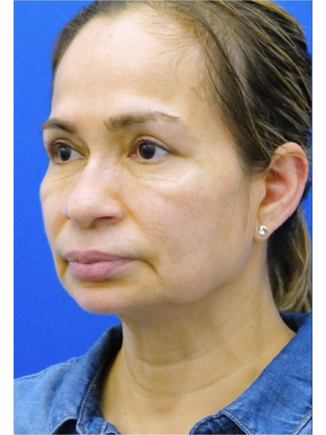 Crisp Jaw Line — Before