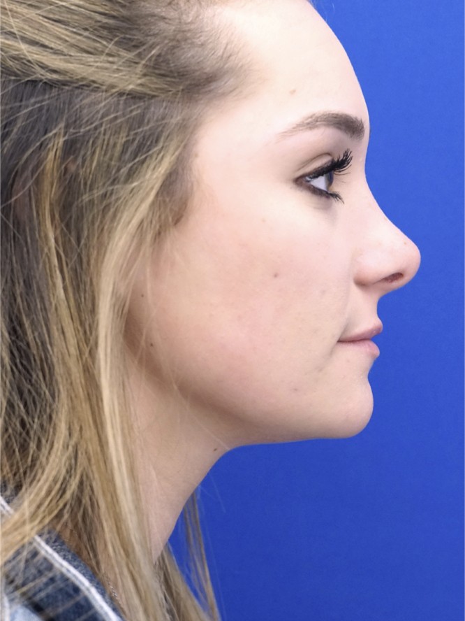Endonasal Profile — After