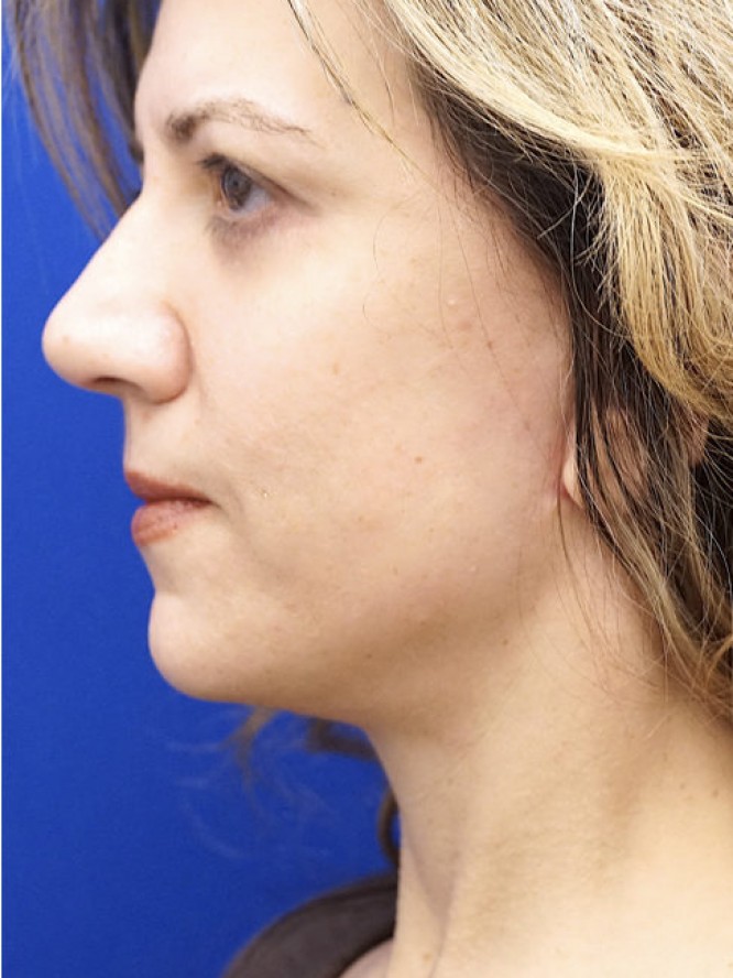 Deep Plane Face Lifting — After