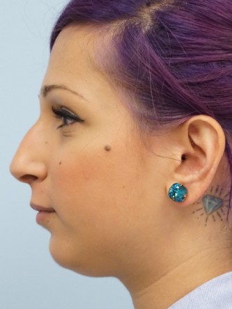 Juvederm Upper and Lower Lip Fillers* — Before