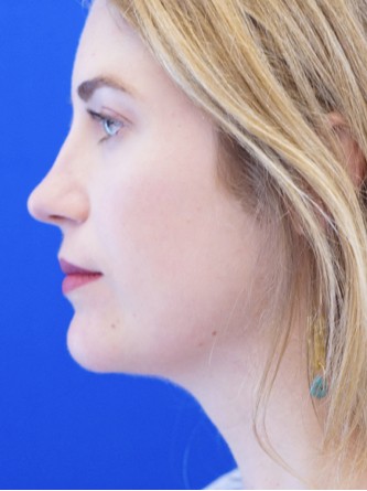 Chin LipoSculpture* — After