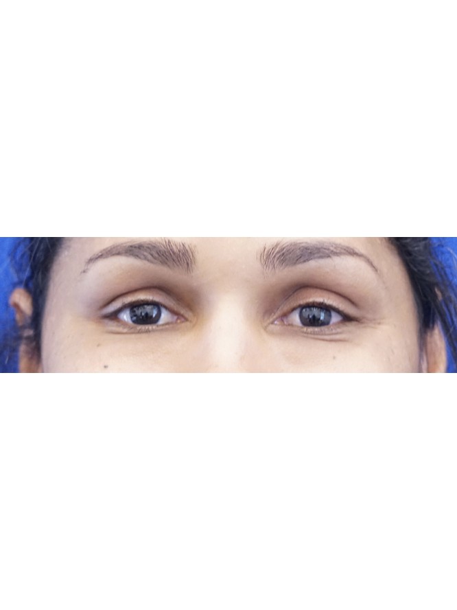 Lower Eyelid Dark Skin Tone — After