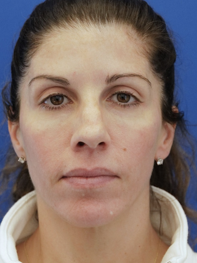 Brow Tip Aesthetic Line — Before