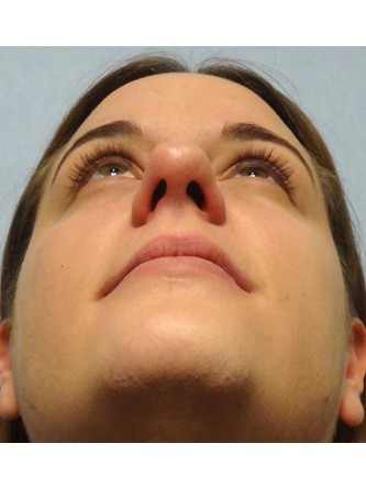 Bulbous Tip* — Before