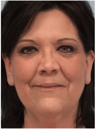 Radiesse to Malar Cheek and Laugh Lines* — Before