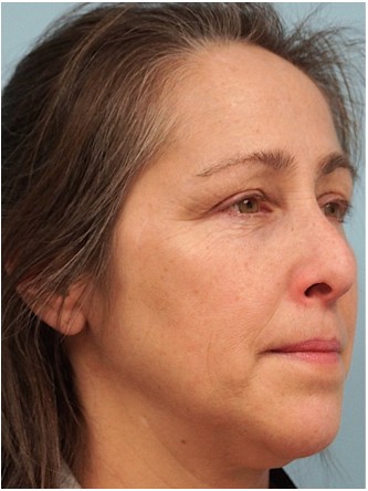 Nasal Septal Perforation2* — Before