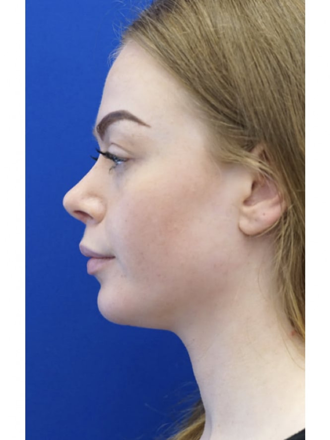 Elegant Nasal and Chin Profile — After