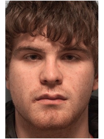Nasal Fracture – Nostril Asymmetry* — After