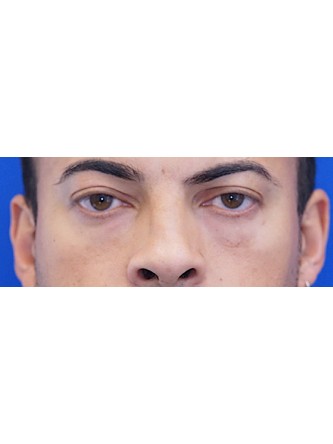 Fat Transfer to Lower Eyelid* — Before