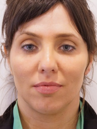 Under Eye Shadow* — Before