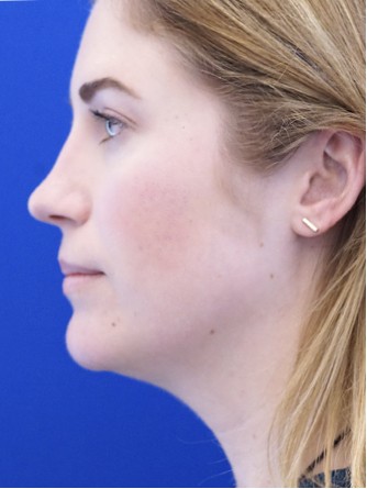 Chin LipoSculpture* — Before