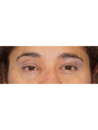 Right Ptosis Repair* — Before