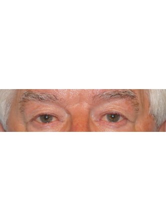 Loose Upper Eyelid Skin* — Before