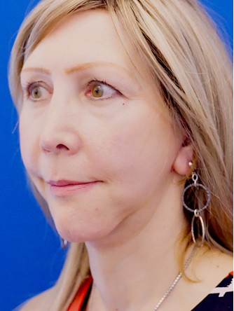 Revision Chin Implant, Mini Lift* — After