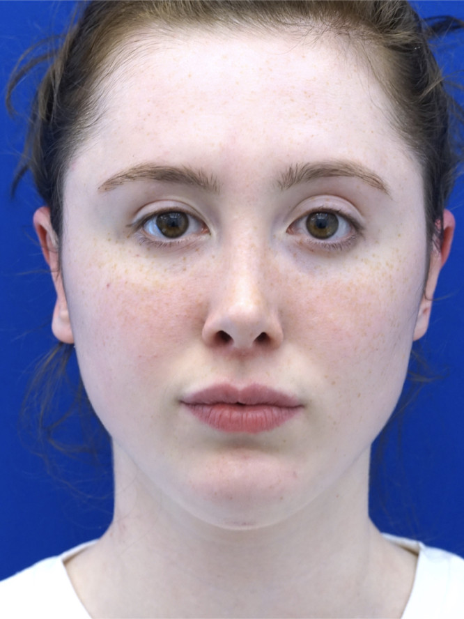 Right Revision Otoplasty — After