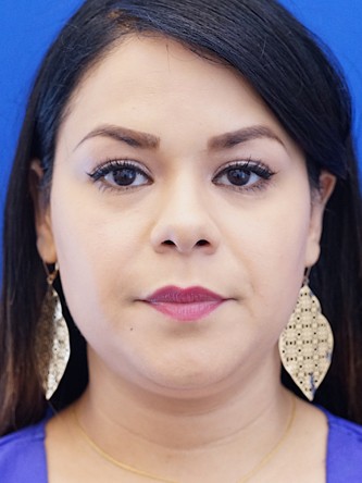 Twin Tear Trough Fillers* — Before