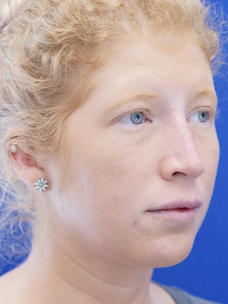Liquid Rhinoplasty* — After