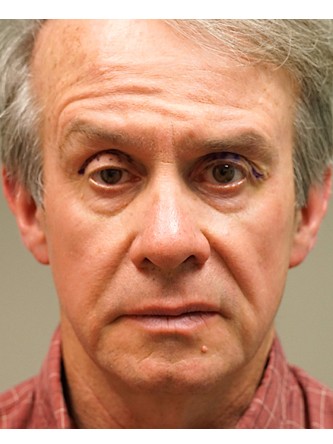 Droopy Eyelid Surgery* — Before