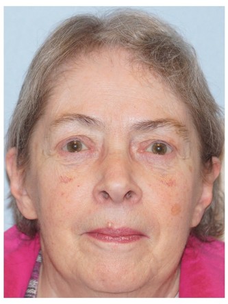 Visual Field Deficit – Eyelid Ptosis3* — After