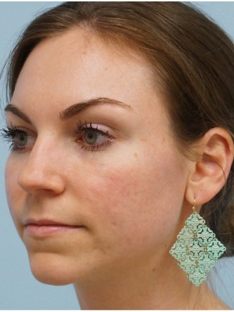 Fractional CO2 Laser Skin Resurfacing1* — After