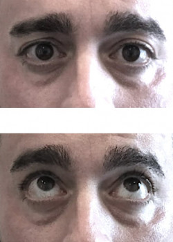 Same Day Tear Trough Result — Before