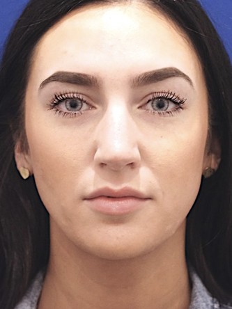 Nasal Hump Closed Rhinoplasty — Before