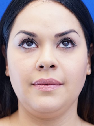 Twin Tear Trough Fillers* — After