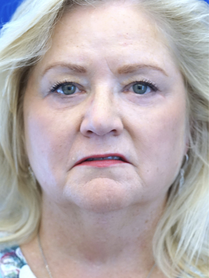 Lower Eyelid Rejuvenation — After