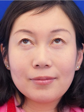 Restylane Silk to Dark Circle* — After