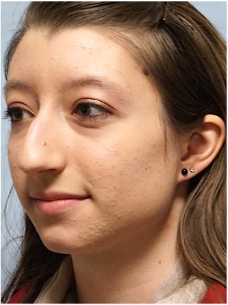 Prominent Nose Closed Rhinoplasty* — Before