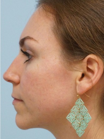 Fractional CO2 Laser Skin Resurfacing1* — After