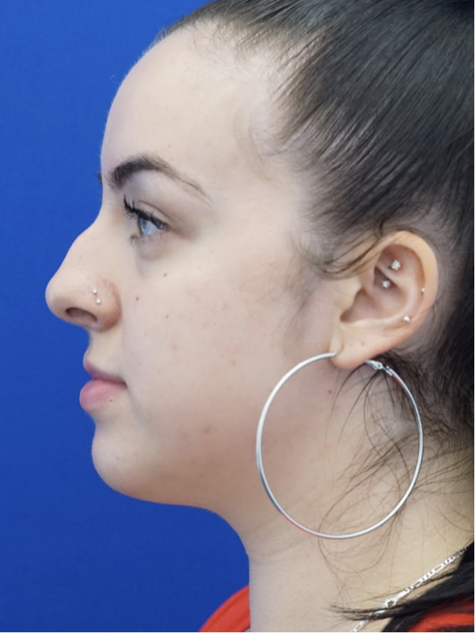 Scarless Hump Reduction — Before