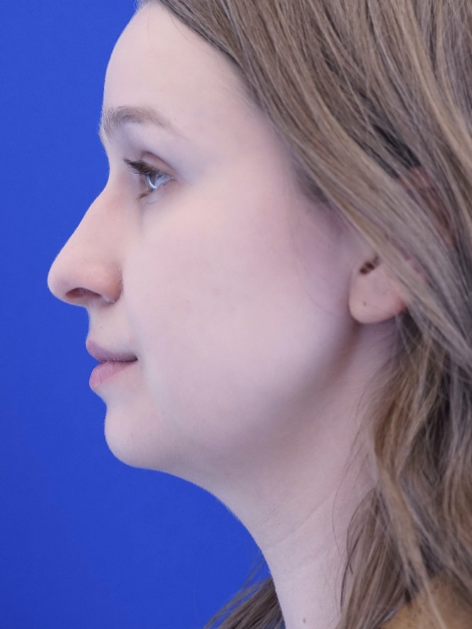Facial Profile Plasty — Before