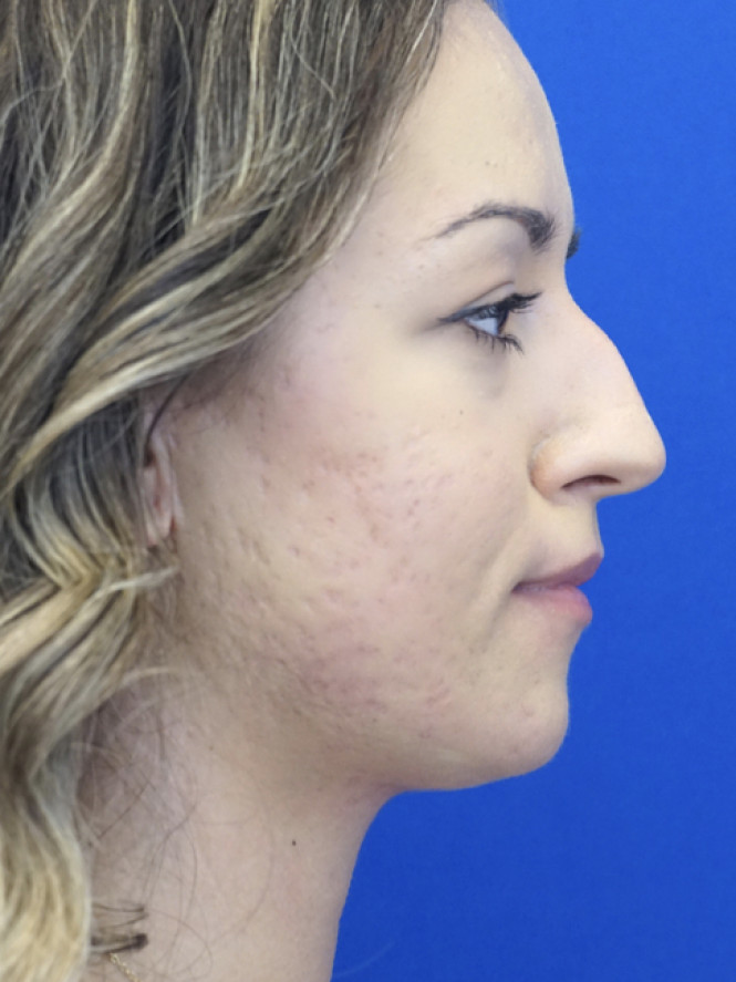 Dorsal Hump Removal — Before
