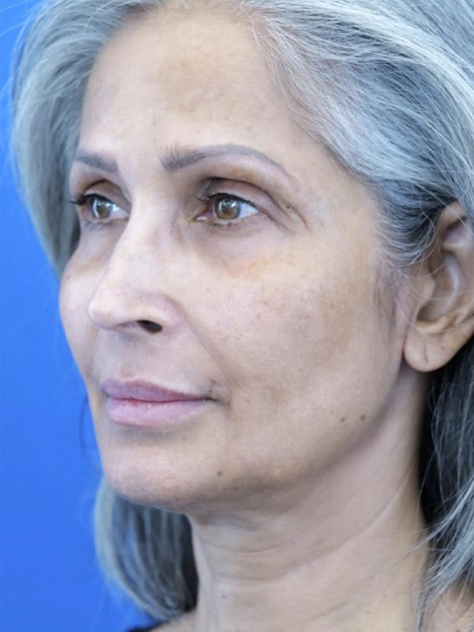 Face and Endobrow Lift — Before