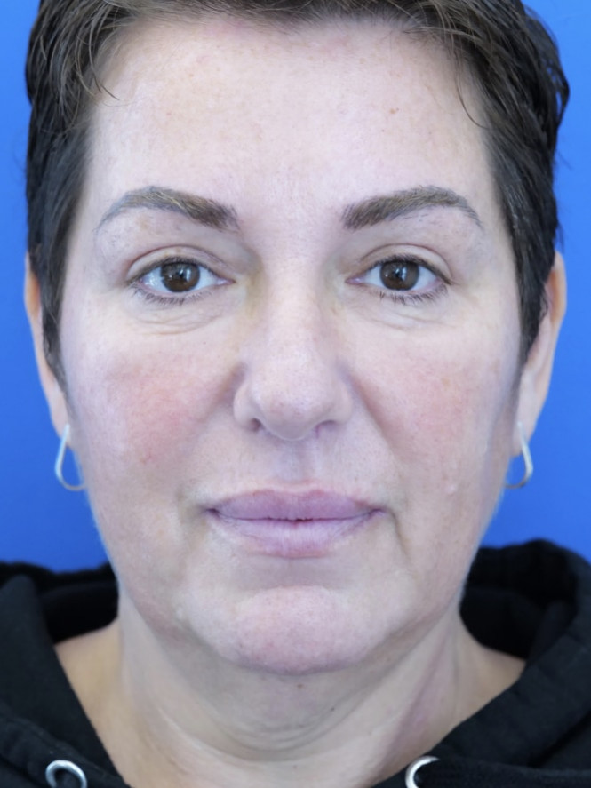 Natural Result — After