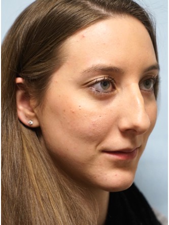 Nasal Hump Endonasal Rhinoplasty* — Before